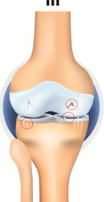 عملية الشق العظمي لعلاج خشونة الركبة
